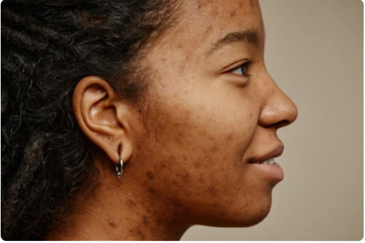 Teen Acne Facial