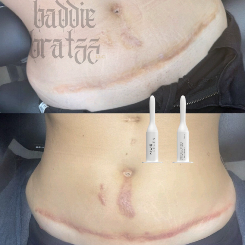 Scar Lightening & Inkless Revision at Baddie Bratzz LLC in Phoenix, AZ