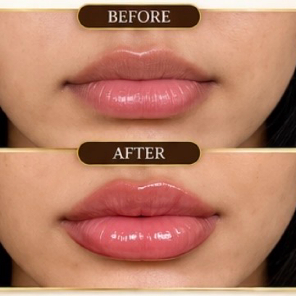 Lips Fillers at Arewa Essential Medspa in Mamaroneck, NY