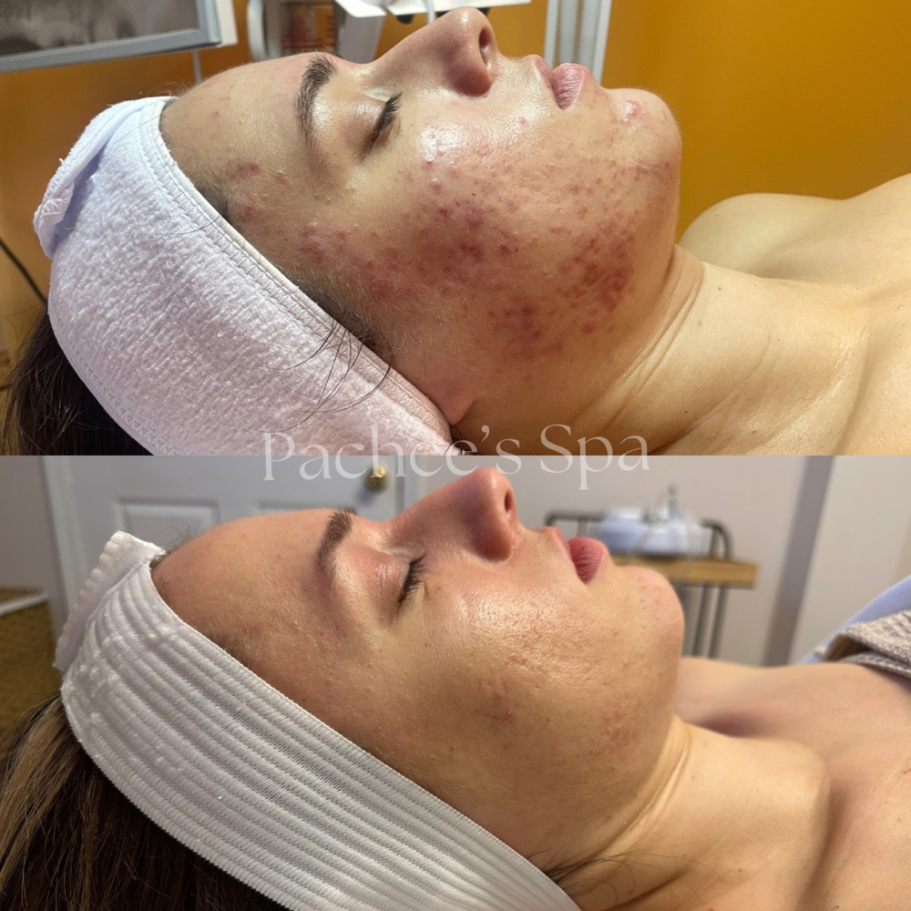 Level IV Treatment - Revive