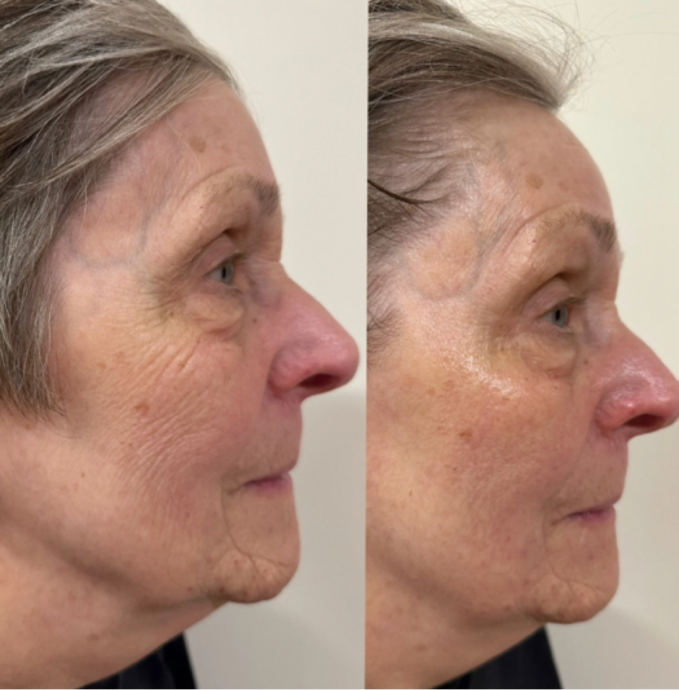 KrX V-Tox "Face Lift Mask" add on at Skin Love Worthington in Worthington, OH