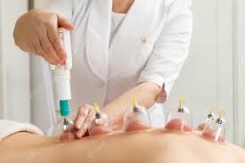 Cupping