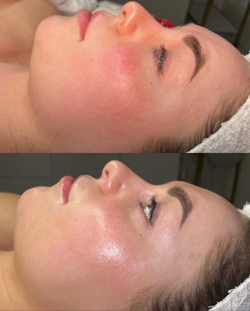 Facial and Dermaplane