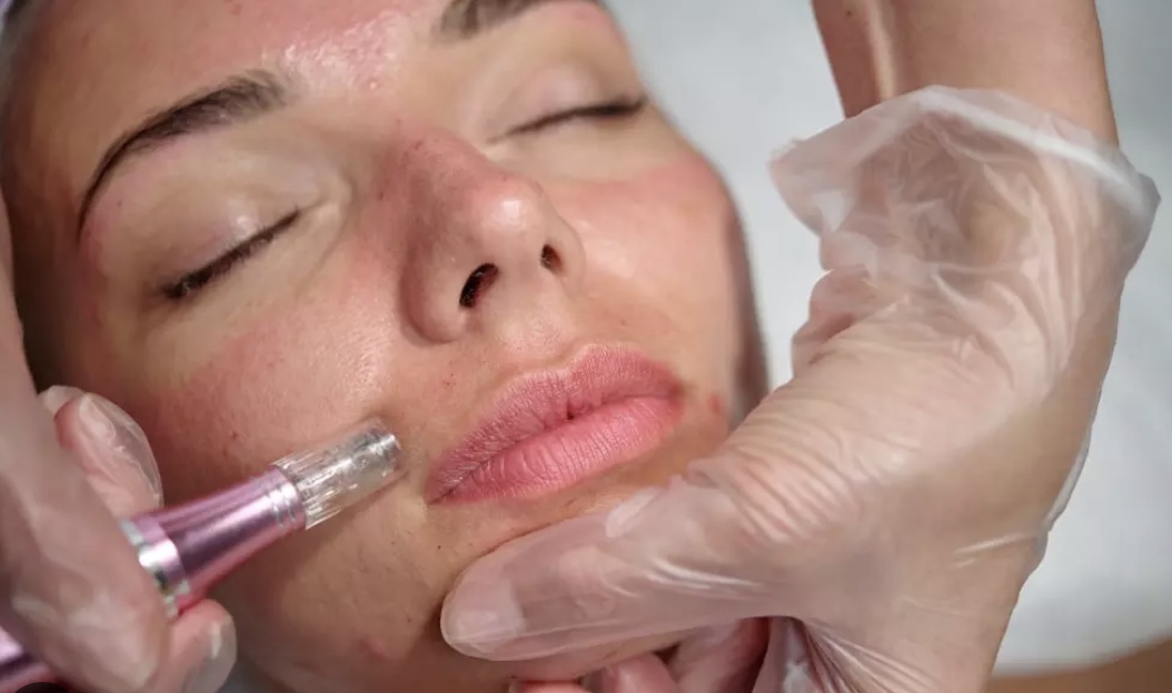 Microneedling - Single Session