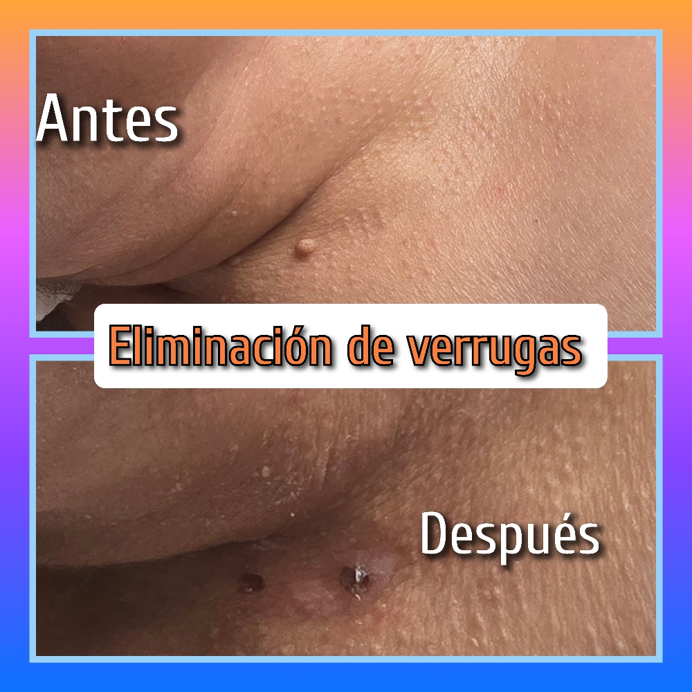 Eliminar Berrugas