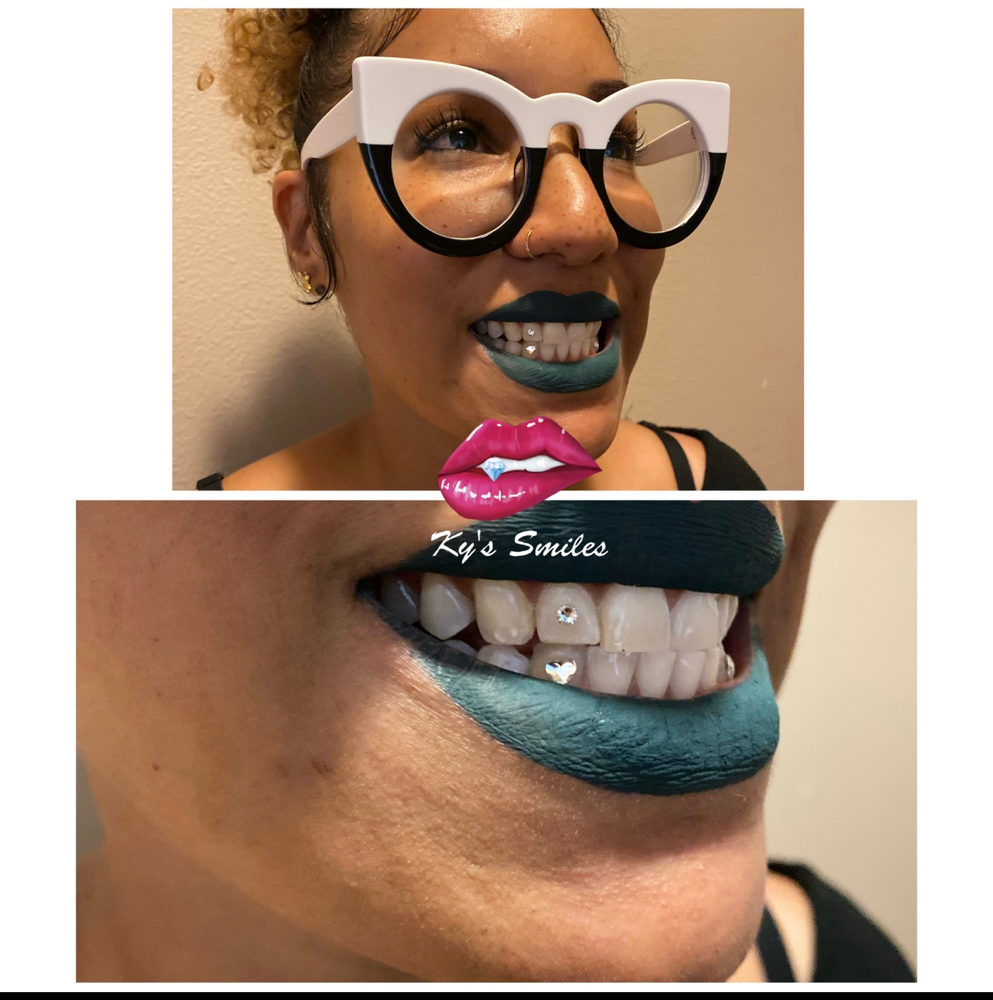 Tooth Gem Placement