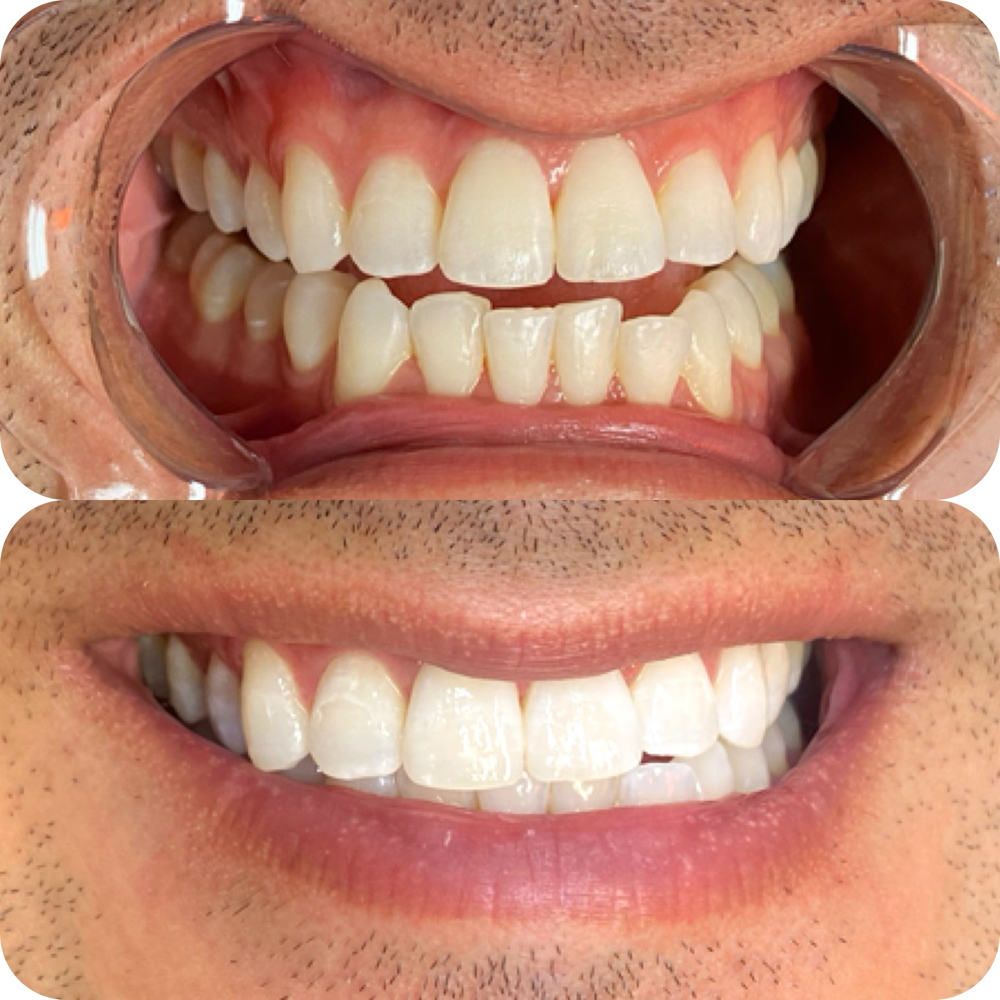 1HR Teeth Whitening session at Painted Beauty in Fresno, CA
