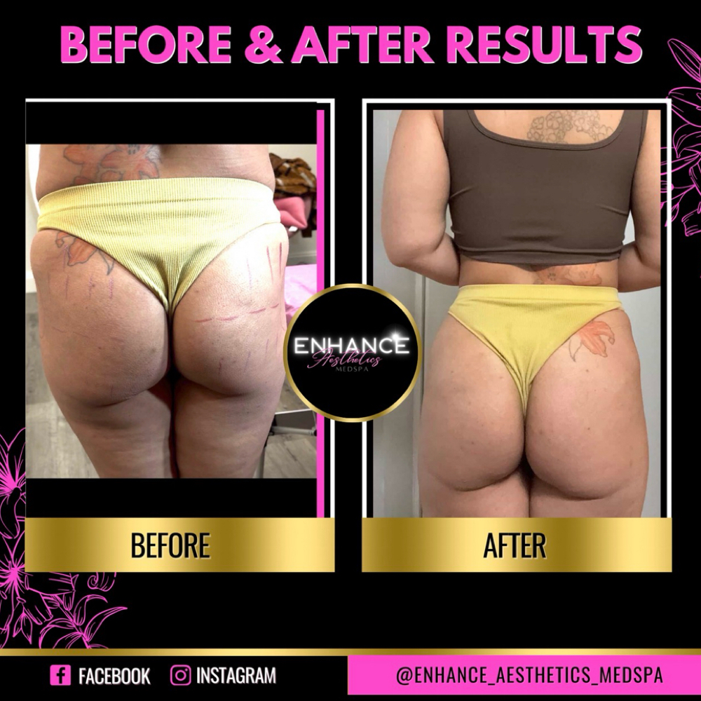 Liquid Bbl With Sculptra at Enhance Aesthetics Medspa in Arlington, TX