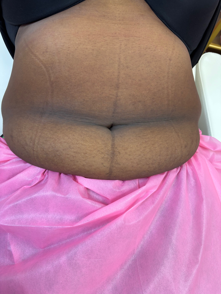 Lymphatic Drainage Massage