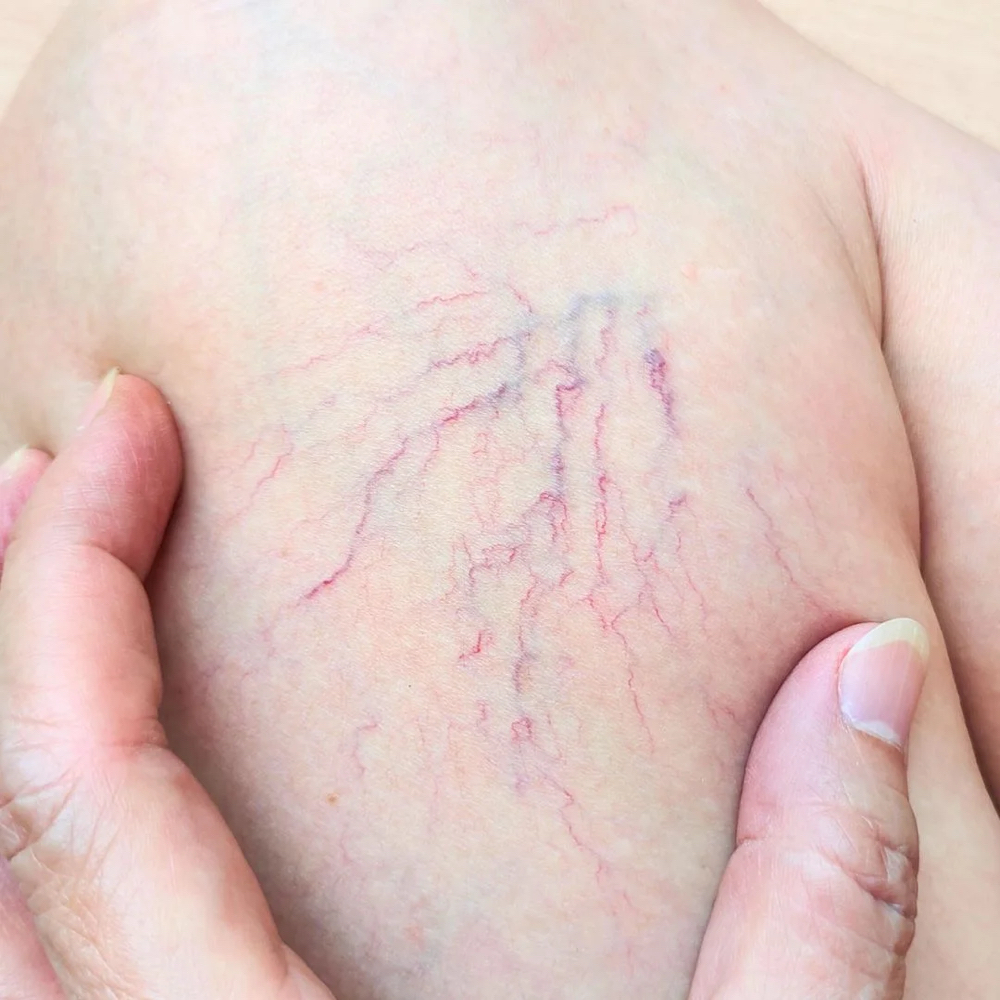 SPIDER VEINS / CHERRY ANGIOMAS at BEAUTY LAB COLLECTIVE in Miami, FL