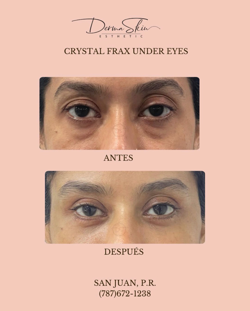 Crystal Fraxx Under Eyes