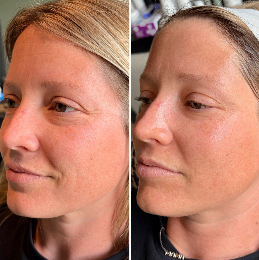 KPx Pore Fix Peel at KPx in Saint Charles, MO