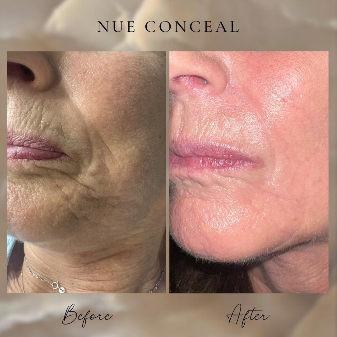 Wrinkle Advanced Inkless Treatment