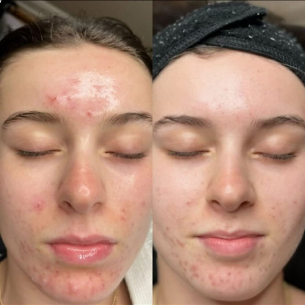Acne Lift Peel at Bare Beauty By Alexis in Bay Saint Louis, MS