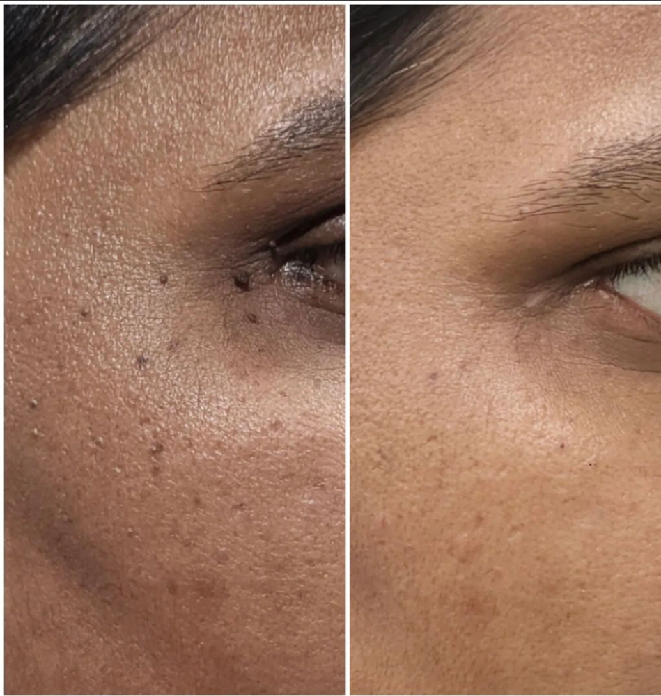 Skin Tag Removal