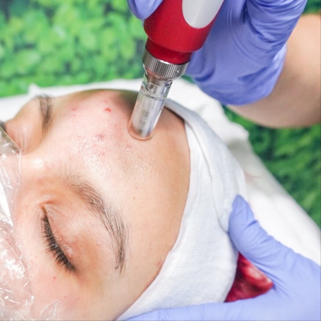 Microneedling at FaceMe Skin Care in Bloomingdale, IL