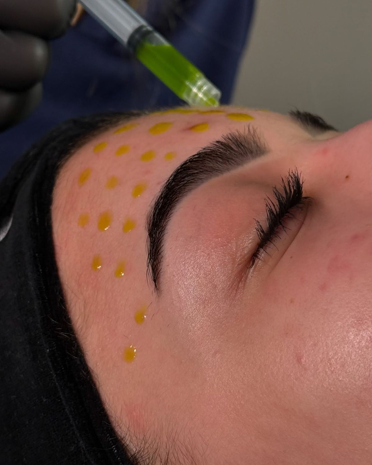 BioRePeel & Dermaplane