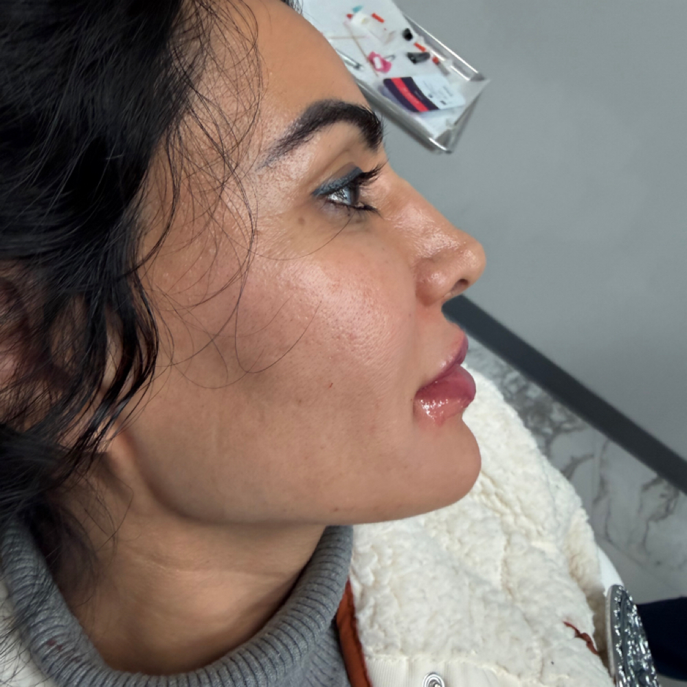 Jawline Structure at Atelier Aesthetics and Infusions in Dallas, TX