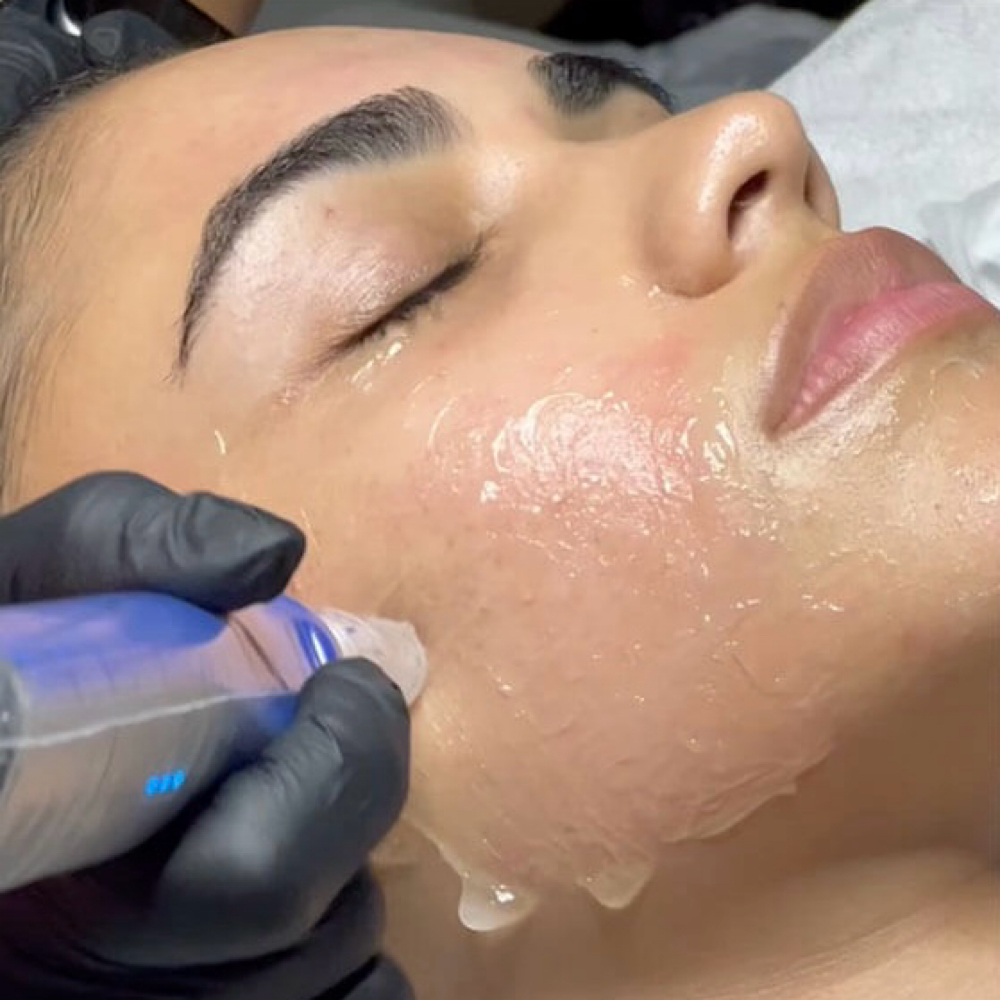 Microneedling w/ AnteAGE® Stemcells at Classy Contouring in Mesa, AZ