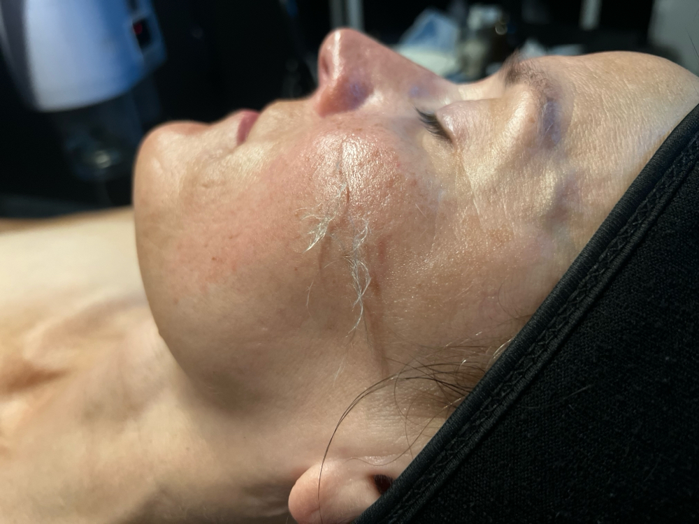 Dermaplaning