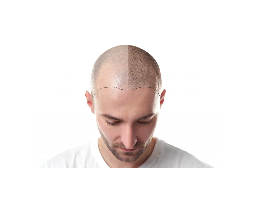 SCALP MICROPIGMENTATION
