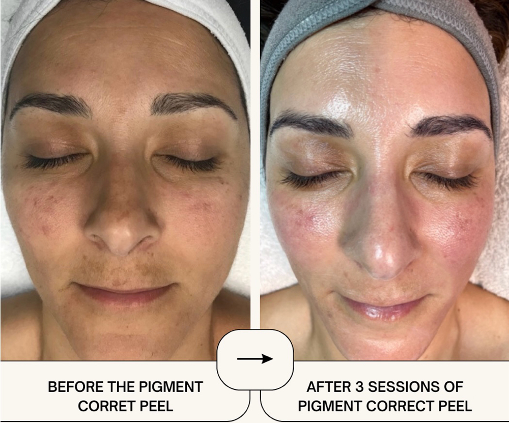 NEW! Pigment Correct Facial