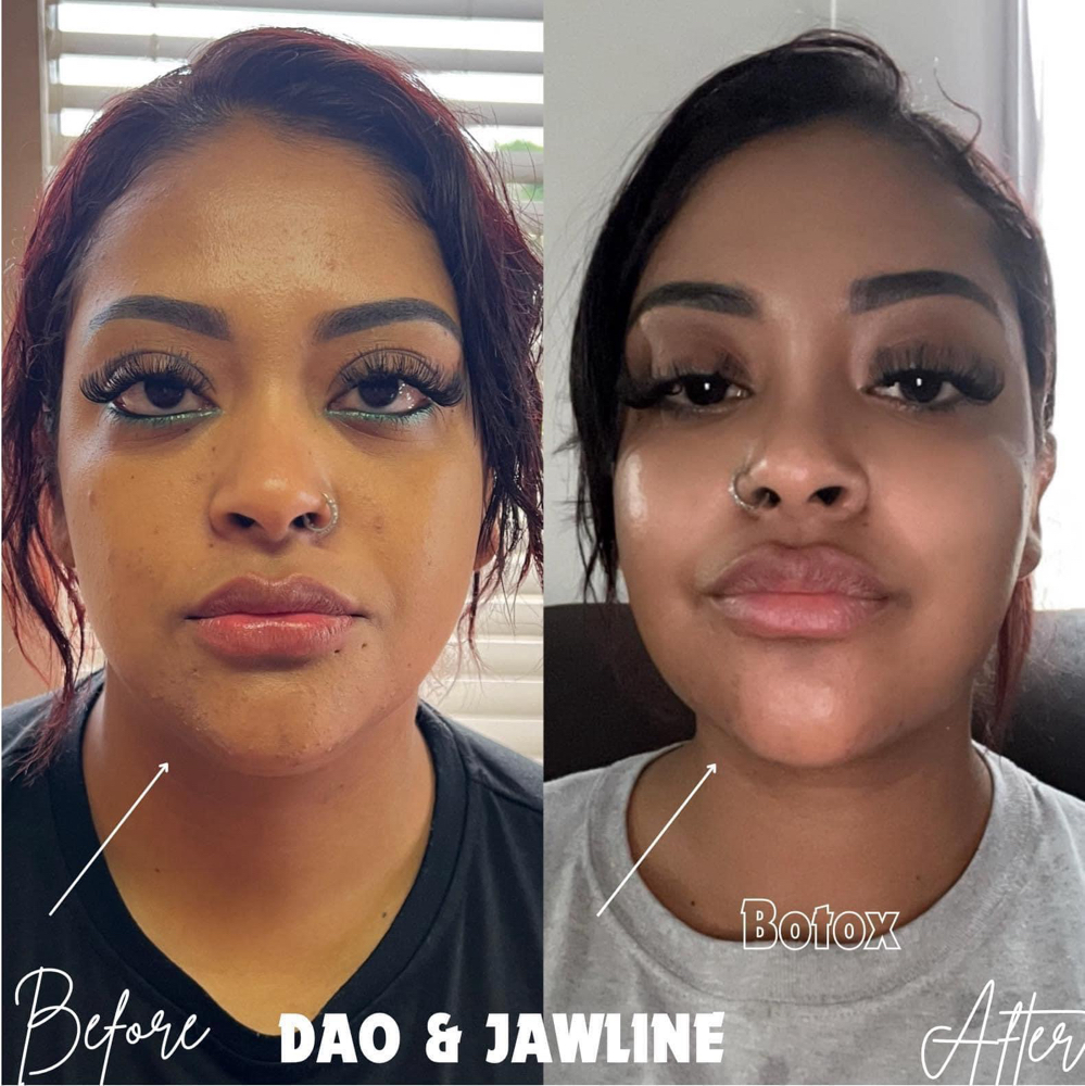 Tox-Snatched Jawline/Lower Lift at BeautyHolic Aesthetics LLC in Lubbock, TX