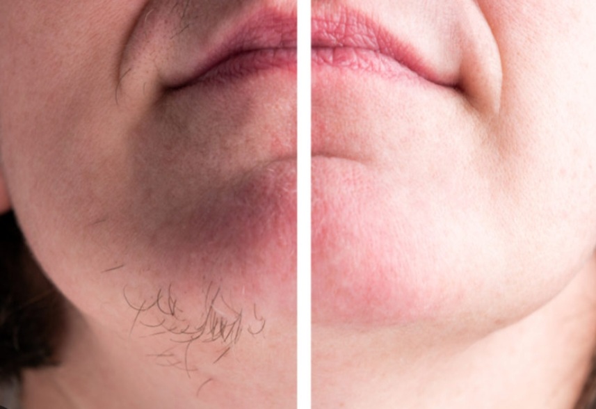 Partial Chin Wax