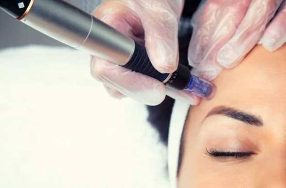Microneedling (C.I.T.) Treatments