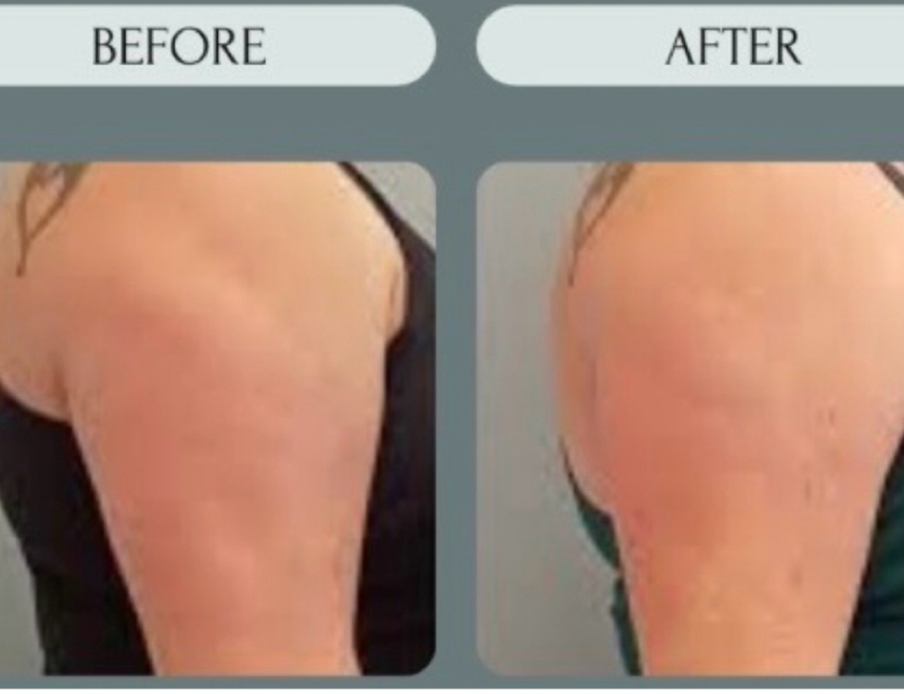 Cryotherapy Arms at LumenHeart with Chenoa in Loomis, CA