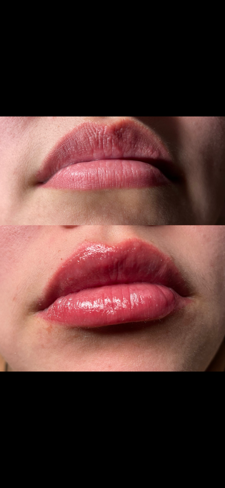 Lip Filler