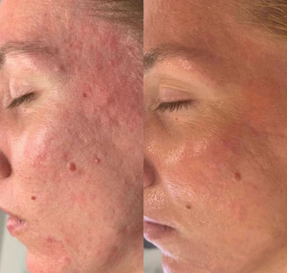 Microneedling