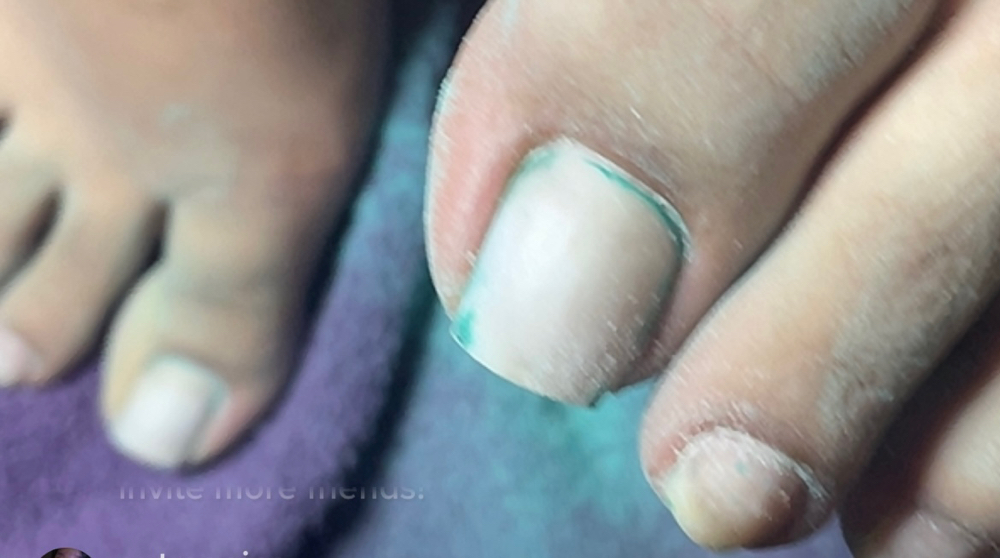 2 Big Toe Overlay Soak Off