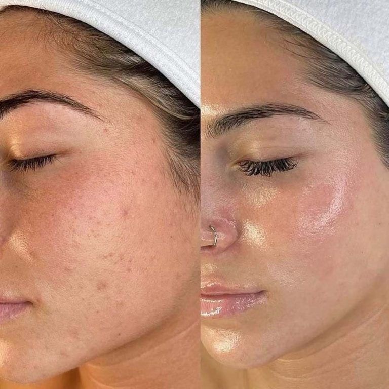 Acne Facial Treatment