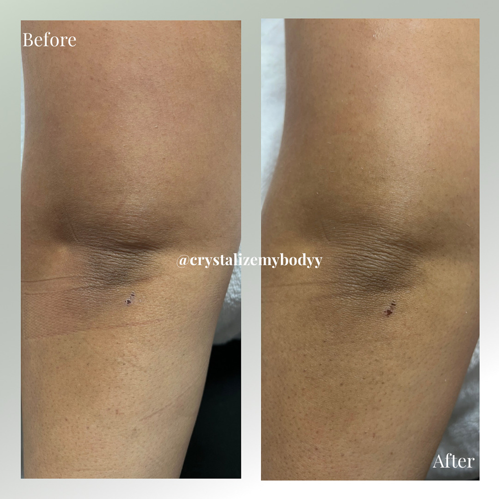 Skin Brightening (3 Sessions)
