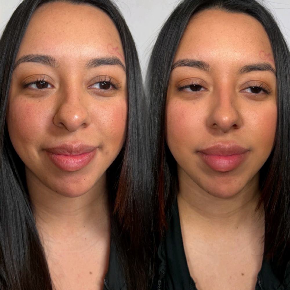 Non-Surgical Rhinoplasty at Eluxy Aesthetics in Arlington, TX