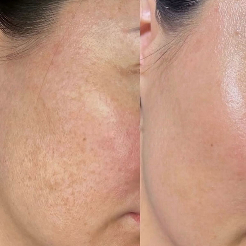 Precision And Peptides VI Peel at J Skin Lab in Hoboken, NJ