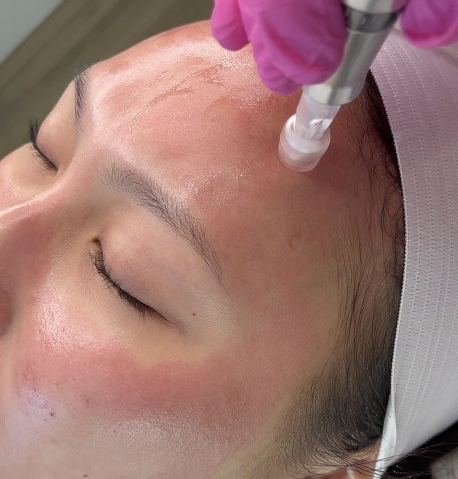 Microneedling