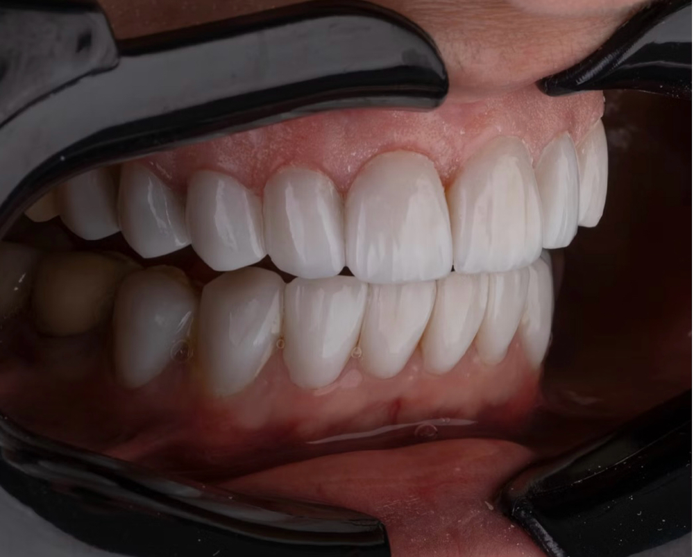 Basic Teeth Whitening