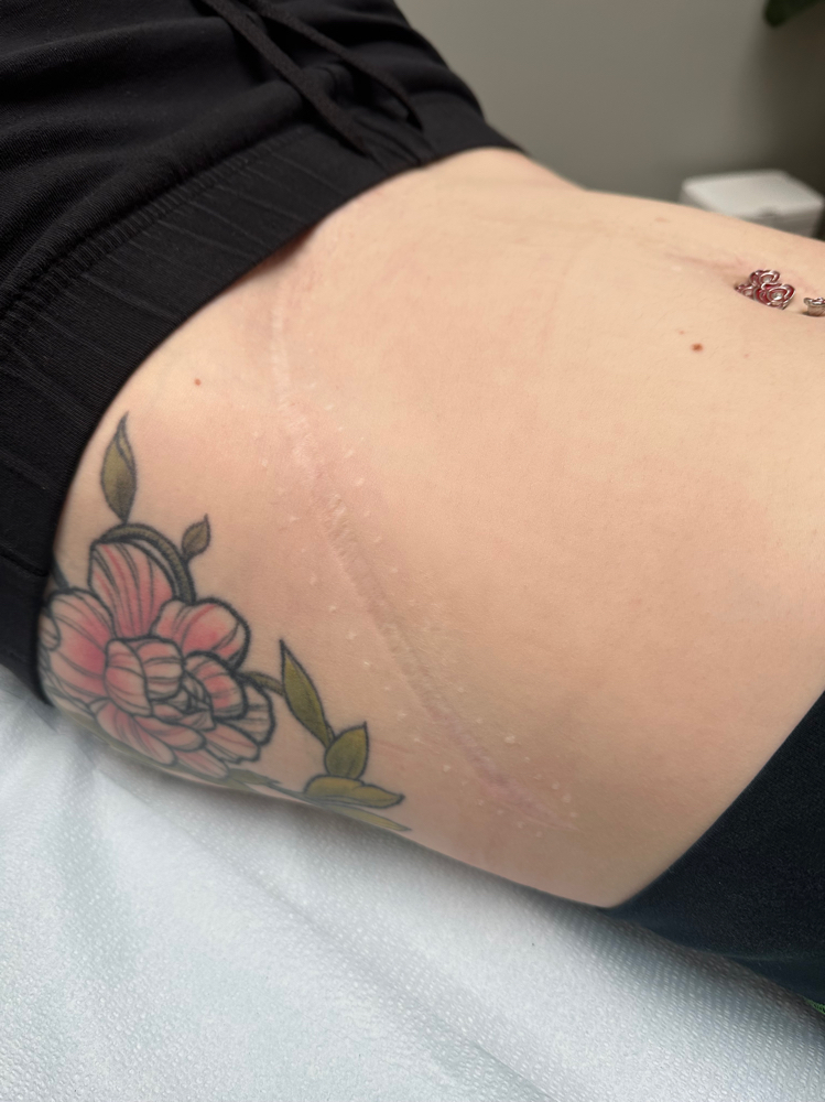 Stretch Mark and Scar Revision