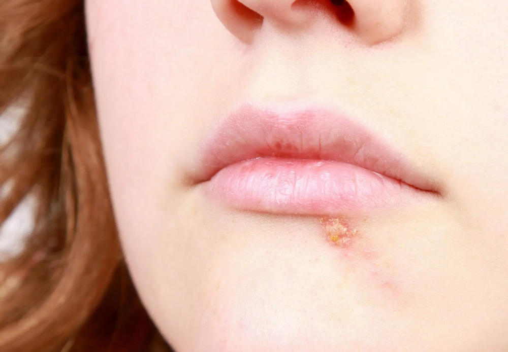 Cold Sore Treatment