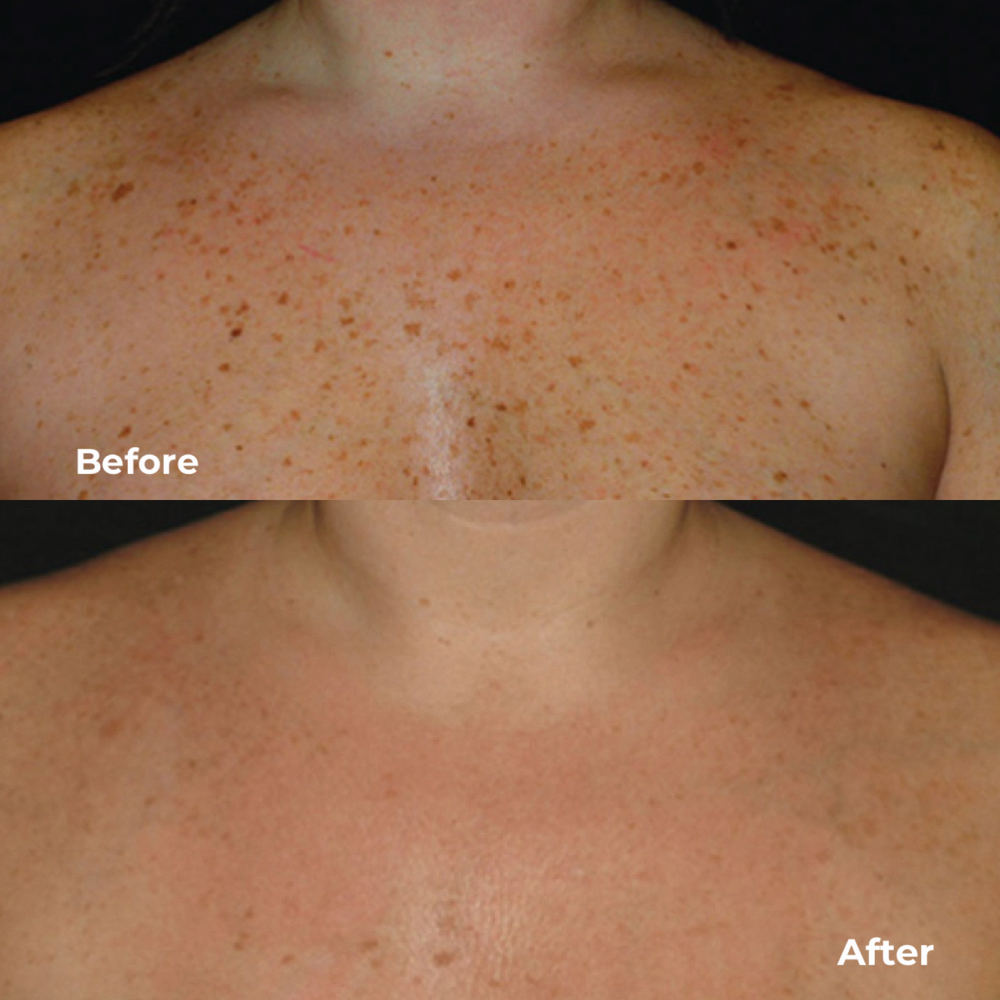 (IPL) Chest at BEAUTY LAB COLLECTIVE in Miami, FL