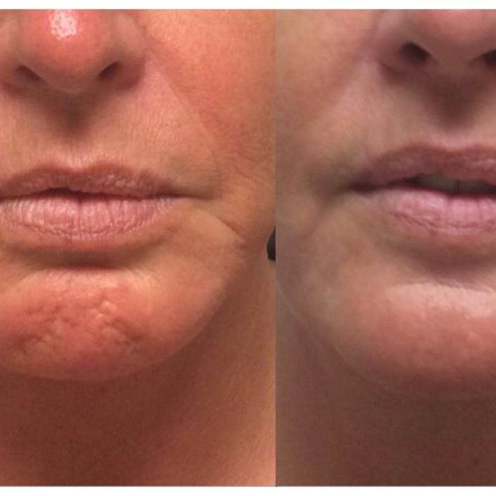 Chin Botox at Abigail Espinoza in Angleton, TX