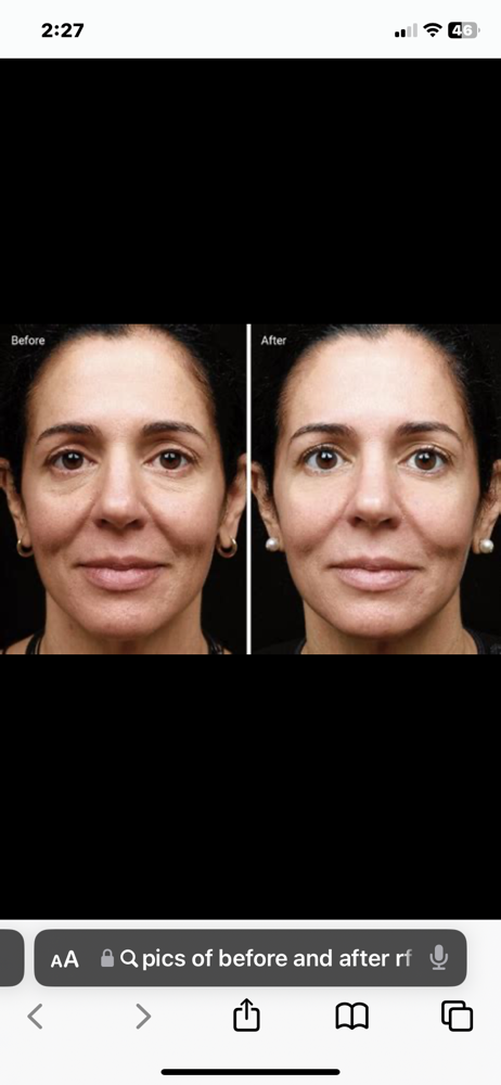 (5)sessions Of RF Facelift