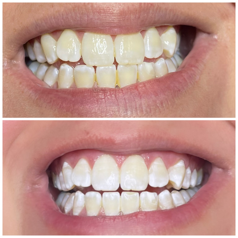 Teeth Whitening