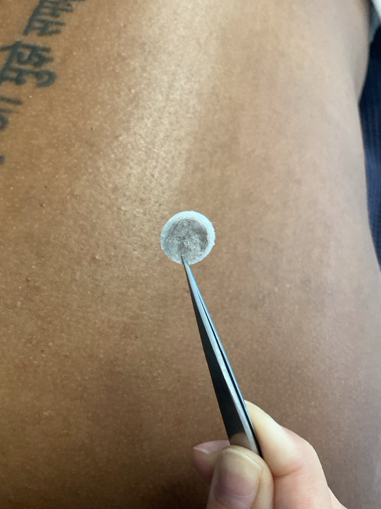 Back Microdermabrasion