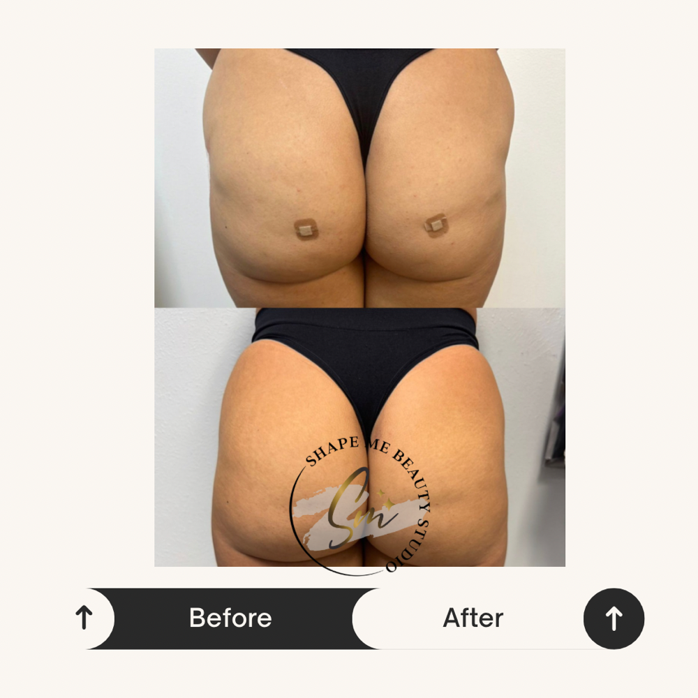 Liquid BBL 200cc at Shape Me Beauty Studio in Midland, TX