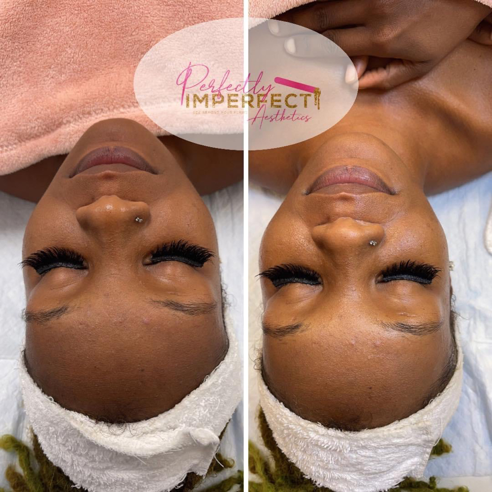 Dermaplane Facial