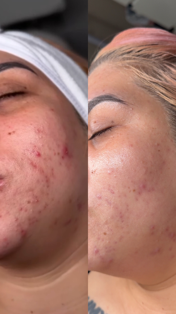 SQT Bio Microneedling Acne Treatment