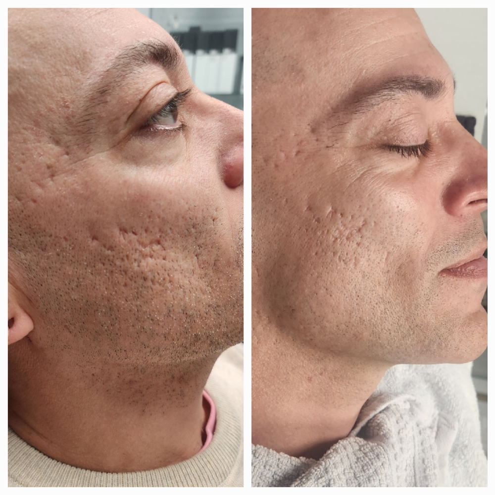 Microneedling With PRF series Of 3